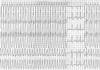 atrial-fibrillationfig4_large (Custom).jpg